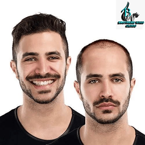 Non-Surgical Hair Replacement Non-Surgical Hair Replacement