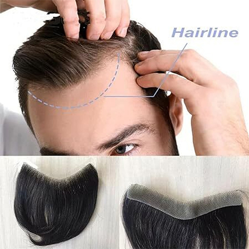 Hair Bonding & Hairline Repair Hair Bonding & Hairline Repair